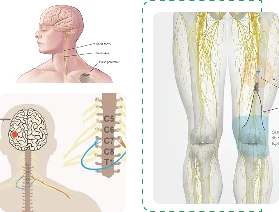 itp implantation