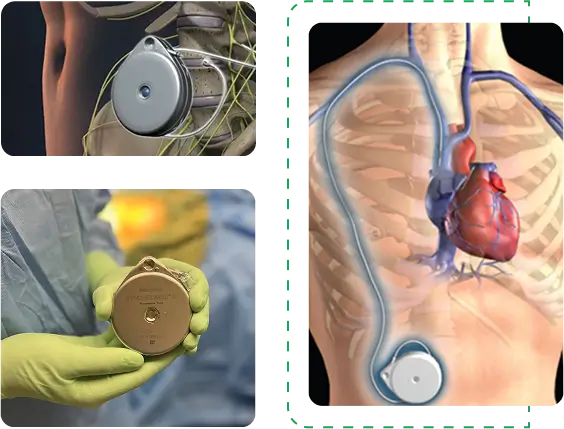 itp trial