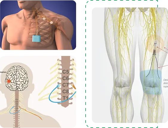 pns implantation
