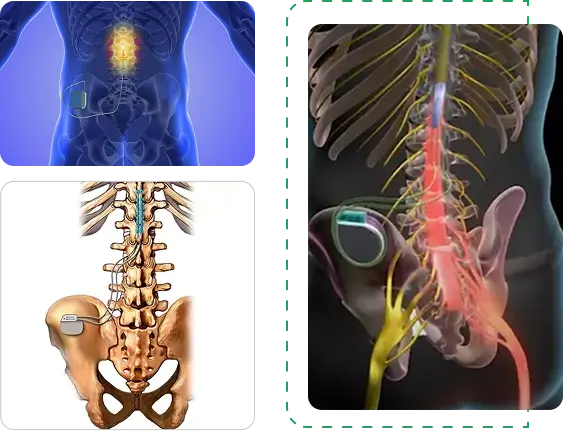 scs implantation